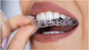 Aligners
