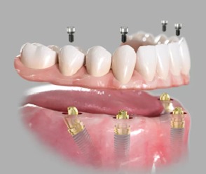 Implants Example
