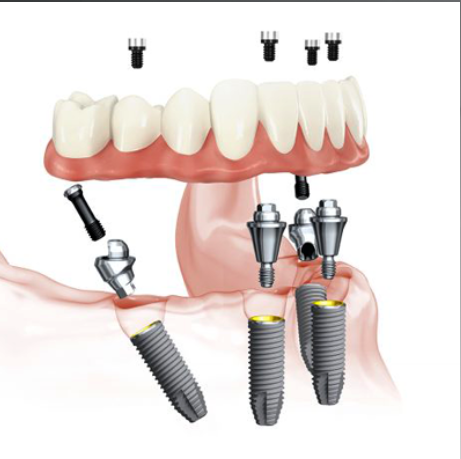 Dental Implants